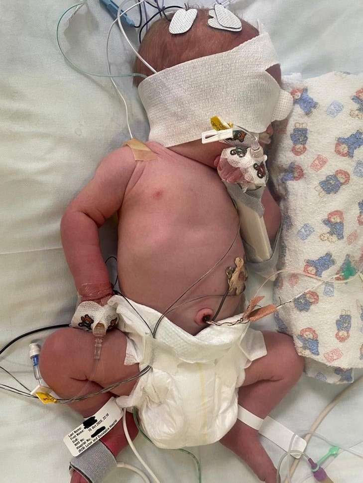 Olly was put on a ventilator and needed monitoring after the birth